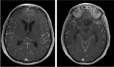 Challenges and Advances in Diagnosis and Treatment of Leptomeningeal Disease (LMD)